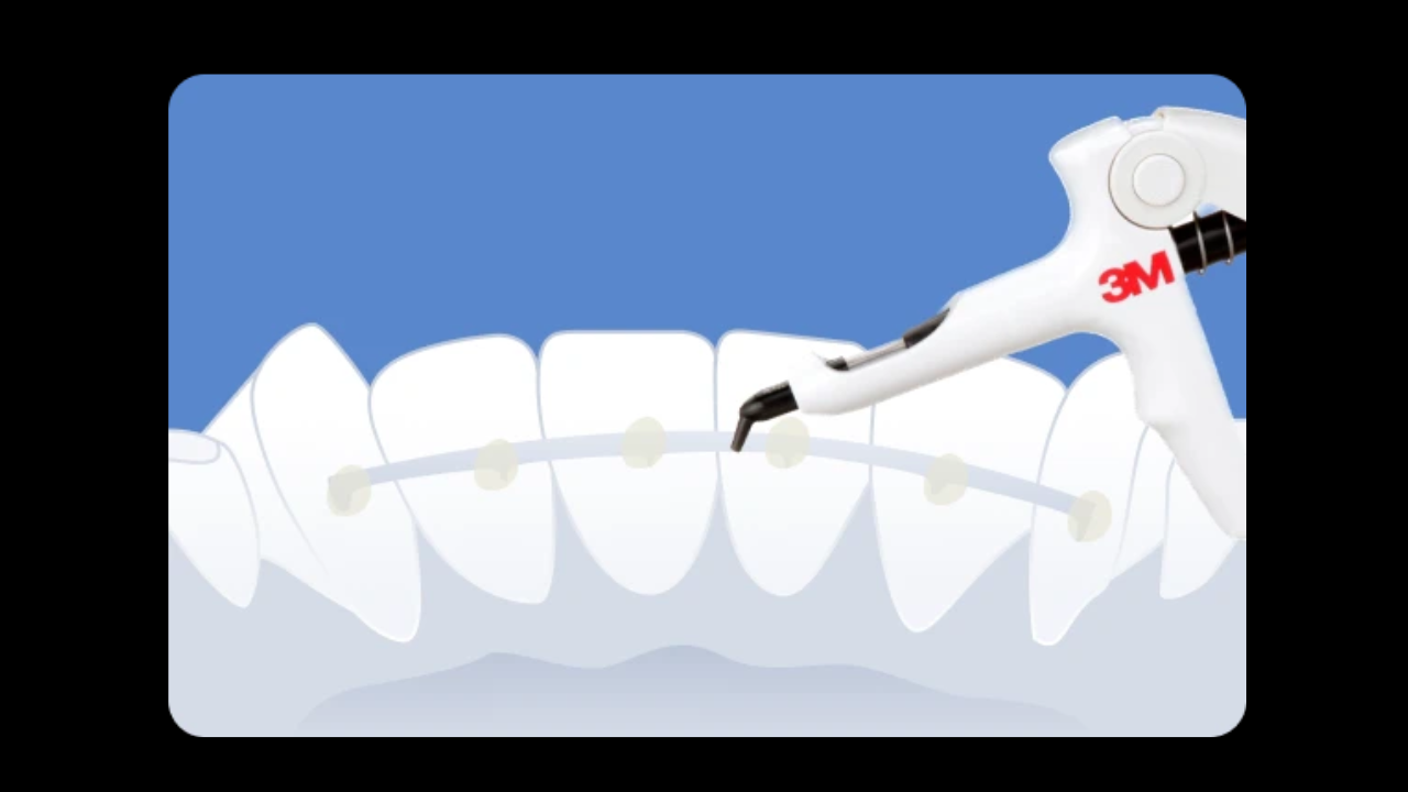 Adieu les urgences : maîtriser le collage des contentions