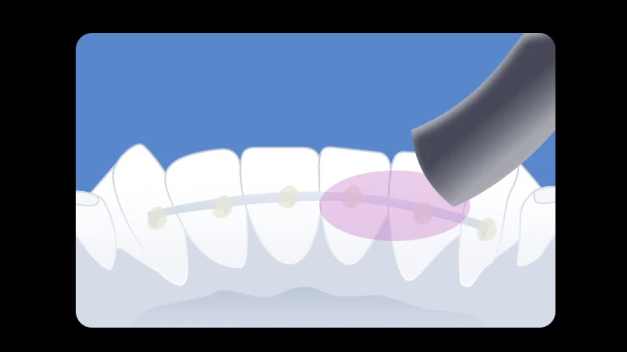 Adieu les urgences : maîtriser le collage des contentions