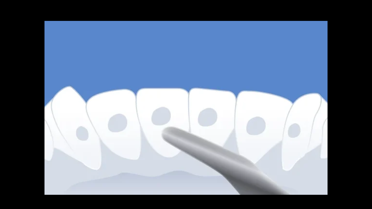 Adieu les urgences : maîtriser le collage des contentions